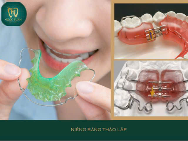 niềng răng tháo lắp hiệu quả thấp